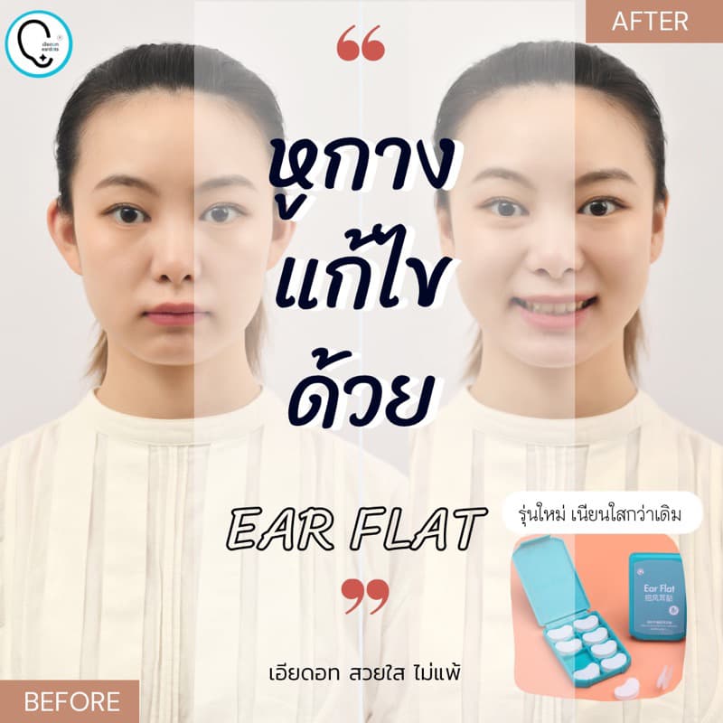 **ส่งแมสด่วนได้จากกทม.ทักแชท**แก้ปัญหาหูกางด้วย Ear flat รุ่นเด็กและผู้ใหญ่ ใช้คู่กาวรียูสใช้ซ้ําได้_OP017