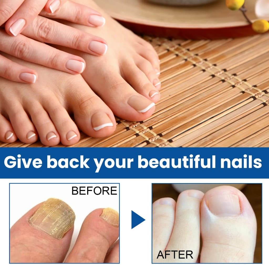 West&Month เล็บเชื้อรา Nail repair serum รักษาเชื้อราเล็บ รักษาเล็บขบ ฆ่าเชื้อราที่เล็บ น้ำยาบำรุงเล็บ… รูปที่ 1