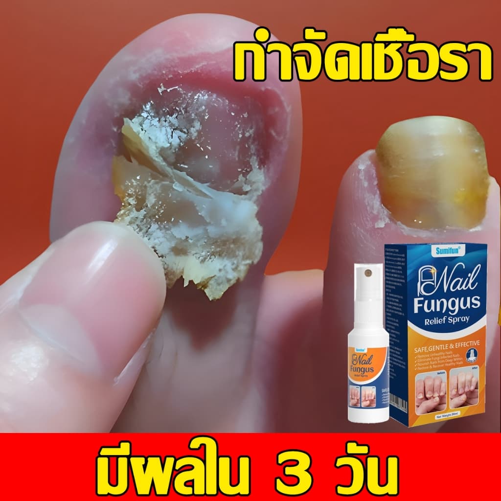เซรั่มบำรุงเล็บ Sumifun รักษาเชื้อราเล็บ รักษาเล็บขบ ฆ่าเชื้อราที่เล็บ น้ำยาบำรุงเล็บ เชื้อราที่เล็บ รูปที่ 1