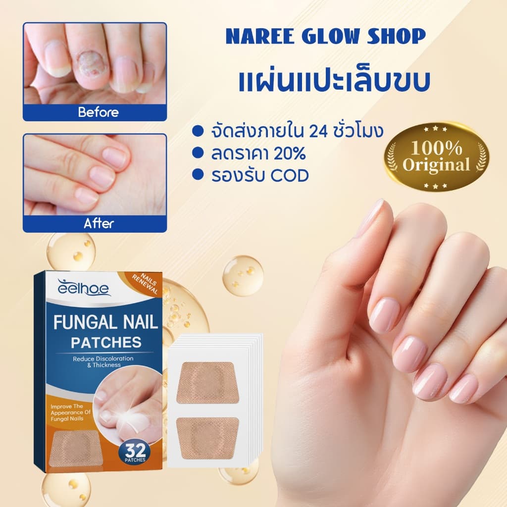 EELHOE แผ่นแปะเล็บขบ เล็บขบ ซ่อมเล็บ เทปแปะป้องกันเล็บขบนิ้วเท้า แผ่นแปะดูแลเล็บเท้า สติ๊กเกอร์เล็บขบ… รูปที่ 1