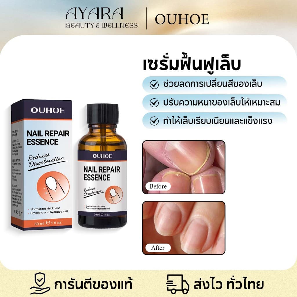 OUHOE น้ำยาฟื้นฟูเล็บ น้ำยารักษาเชื้อราที่เล็บ กำจัดเล็บเสีย เชื้อราเล็บ รักษาเล็บขบ ฆ่าเชื้อราเล็บ รูปที่ 1